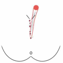 Coccyx Fistula Forms Proctological Practice Munich