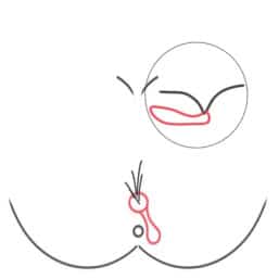 Pilonidal sinus type III Proctological practice Munich