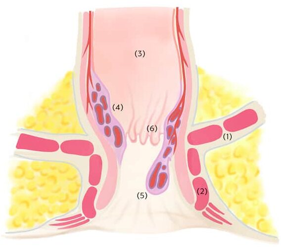 Schema-Hämorrhoiden | Proktologische Praxis München