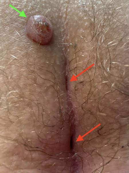 Steißbeinfistel mit 2 Eintrittspforten