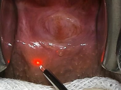 Laser OP mit Diodenlaser