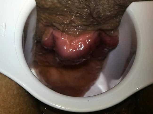 Hämorrhoidenknoten im Proktoskop