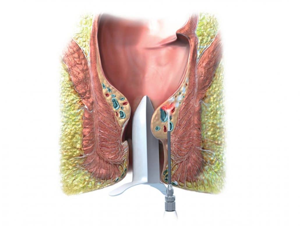 Laser treatment of haemorrhoids with the LHP procedure