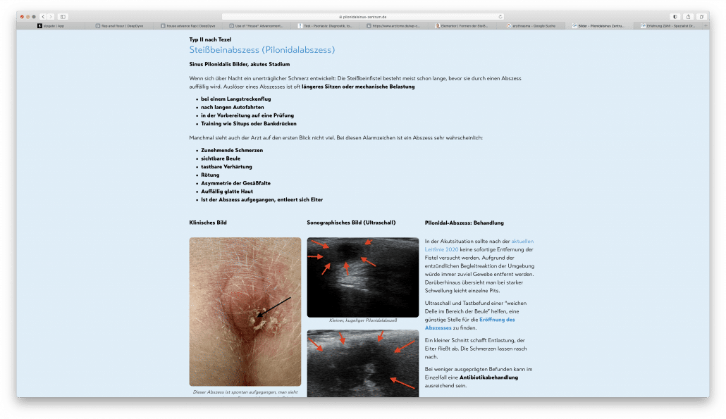 Link to the website Coccygeal Fistula