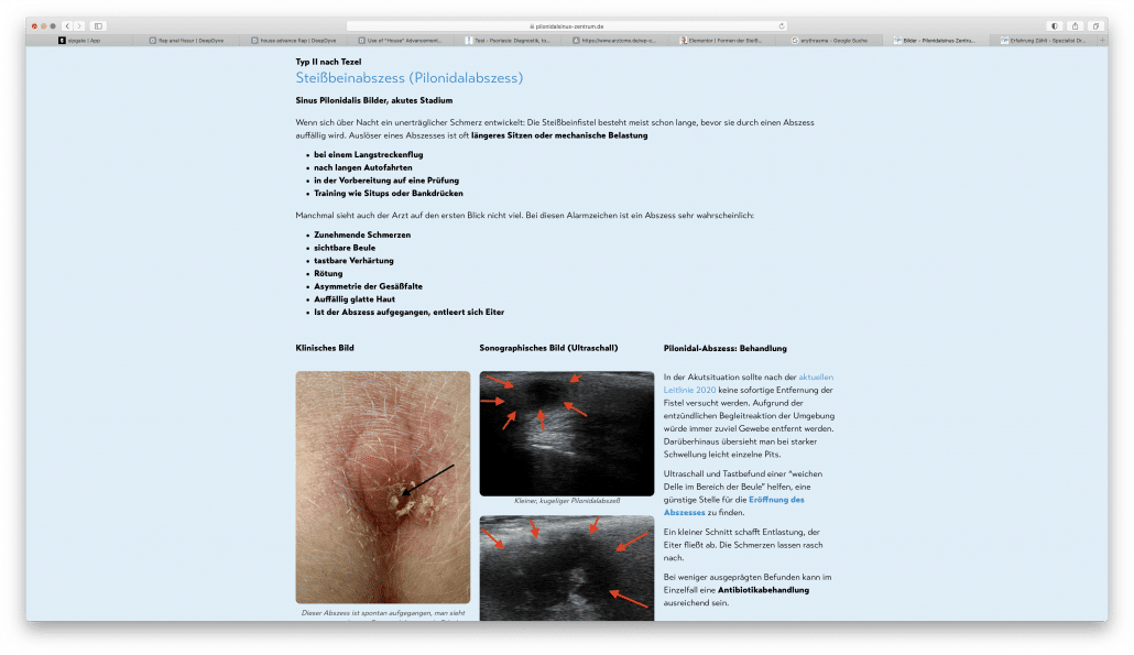 Coccygeal fistula forms: Classification into 4 types