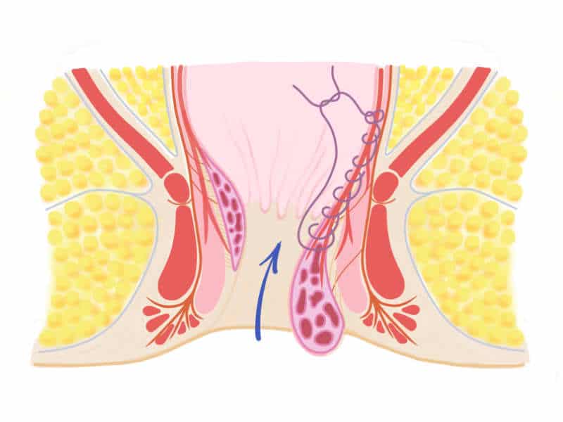 Schema HAL-RAR zur Raffung von Hämorrhoiden