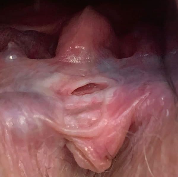 Image of a chronic anal fissure with secondary changes