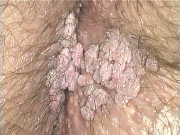 Condylomata accuminata - flat extension of genital warts on the anus