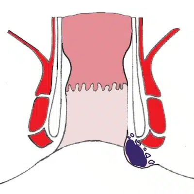 Analthrombose ist die häufigste Ursache von Ausstülpungen oder Vorwölbungen am Anus
