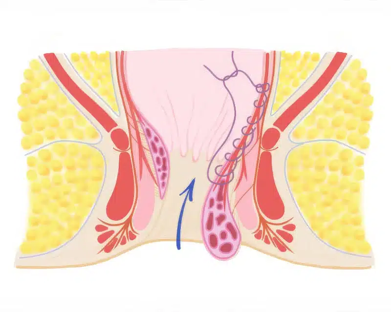 Stabilisierung und Raffung bei Hämorrhoidenvorfall durch HAL-RAR bei Dr. Hofer München