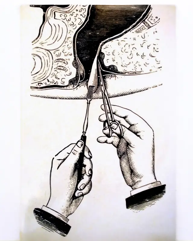 Historische Darstellung einer Hämorrhoidenoperation - Entfernung