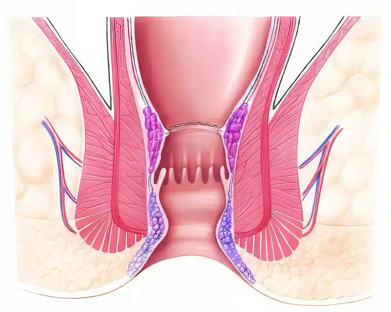 Klammernaht Operation bei Hämorrhoiden